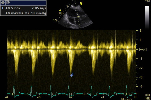 Behandeling Aortastenose