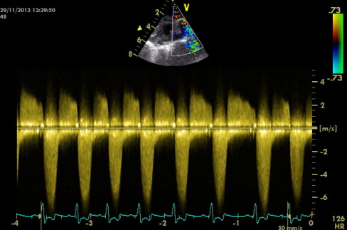 Behandeling Pulmonaalstenose