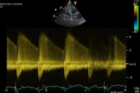 Behandeling persisterende ductus arteriosis Botalli (PDA)